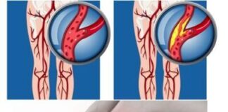 BACAK DAMAR TIKANIKLIĞI NASIL BULGU VERİR?
